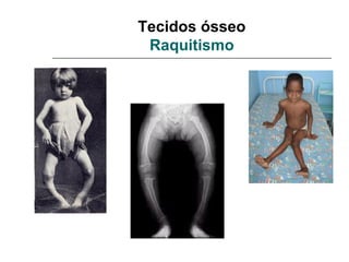 Tecidos ósseo
 Raquitismo
 