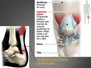 TENDÃO CALCÂNEO
LESIONADO
 