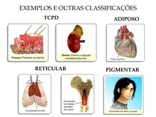 EXEMPLOS E OUTRAS CLASSIFICAÇÕES
TCPD ADIPOSO
RETICULAR PIGMENTAR
 