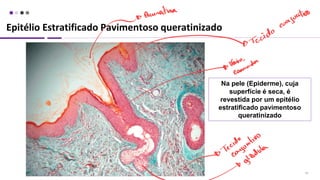 20
Na pele (Epiderme), cuja
superfície é seca, é
revestida por um epitélio
estratificado pavimentoso
queratinizado
Epitélio Estratificado Pavimentoso queratinizado
 