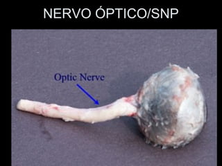 NERVO ÓPTICO/SNP
 