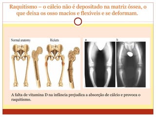 Raquitismo – o cálcio não é depositado na matriz óssea, o
que deixa os osso macios e flexíveis e se deformam.
A falta de vitamina D na infância prejudica a absorção de cálcio e provoca o
raquitismo.
 