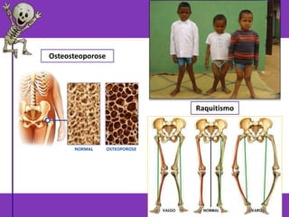 Raquitismo
Osteosteoporose
 
