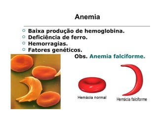 Anemia
 Baixa produção de hemoglobina.
 Deficiência de ferro.
 Hemorragias.
 Fatores genéticos.
Obs. Anemia falciforme.
 