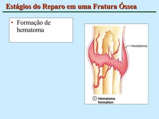 Estágios do Reparo em uma Fratura Óssea Formação de hematoma 