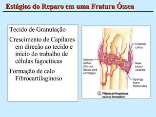 Estágios do Reparo em uma Fratura Óssea Tecido de Granulação Crescimento de Capilares em direção ao tecido e início do trabalho de células fagocíticas Formação de calo Fibrocartilaginoso 