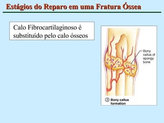 Estágios do Reparo em uma Fratura Óssea Calo Fibrocartilaginoso é substituído pelo calo ósseos 