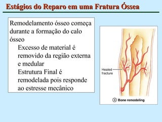Estágios do Reparo em uma Fratura Óssea Remodelamento ósseo começa durante a formação do calo ósseo Excesso de material é removido da região externa e medular Estrutura Final é remodelada pois responde ao estresse mecânico 
