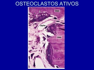 OSTEOCLASTOS ATIVOS
 