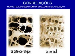 CORRELAÇÕES
MENOS TECIDO ÓSSEO COM AMPLOS ACANAIS DE ABSORÇÃO
 