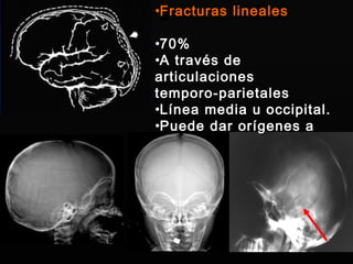 Fracturas lineales 70% A través de articulaciones  temporo-parietales Línea media u occipital. Puede dar orígenes a HED 