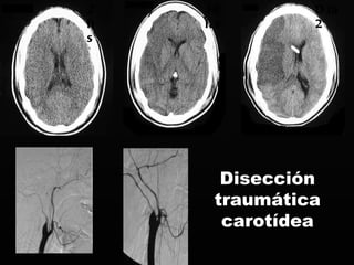 Disección traumática carotídea 2 hs 10hs Día2 