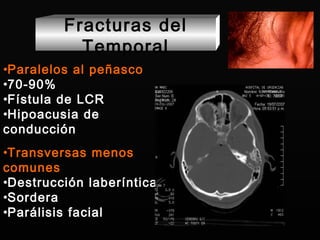Transversas menos comunes Destrucción laberíntica Sordera Parálisis facial Fracturas del Temporal Paralelos al peñasco 70-90% Fístula de LCR Hipoacusia de conducción 