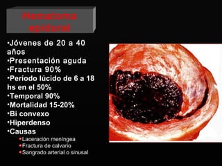 Jóvenes de 20 a 40 años Presentación aguda Fractura 90% Período lúcido de  6 a 18 hs en el 50% Temporal 90% Mortalidad 15-20% Bi convexo Hiperdenso Causas Laceración meníngea Fractura de calvario Sangrado arterial o sinusal Hematoma epidural 