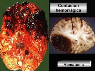 Contusión hemorrágica Hematoma 