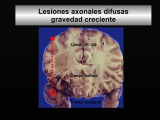 Lesiones axonales difusas gravedad creciente Union SB-SG Cuerpo calloso Tronco cerebral 