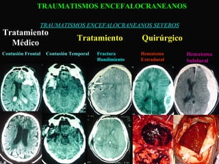 TRAUMATISMOS ENCEFALOCRANEANOS SEVEROS Fractura Hundimiento Hematoma Extradural Hematoma Subdural Contusión Frontal Tratamiento Médico Contusión Temporal Tratamiento  Quirúrgico TRAUMATISMOS ENCEFALOCRANEANOS 