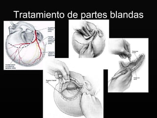 Tratamiento de partes blandas 