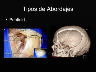 Tipos de Abordajes Penfield 