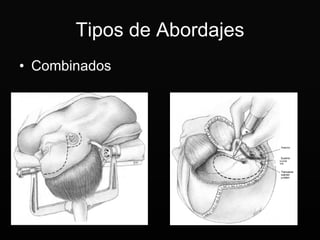 Tipos de Abordajes Combinados 