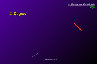 Acidentes em Endodontia PQM 2. Degrau LEONARDO; LEAL 
