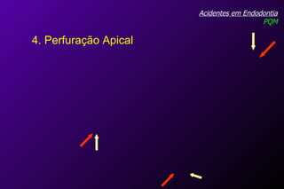 Acidentes em Endodontia PQM 4. Perfuração Apical 