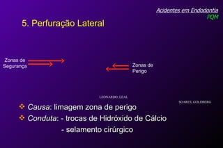 Acidentes em Endodontia PQM 5. Perfuração Lateral Causa : limagem zona de perigo Conduta : - trocas de Hidróxido de Cálcio - selamento cirúrgico Zonas de Segurança Zonas de Perigo LEONARDO; LEAL SOARES; GOLDBERG  
