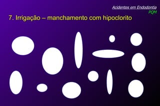 Acidentes em Endodontia PQM 7. Irrigação – manchamento com hipoclorito 