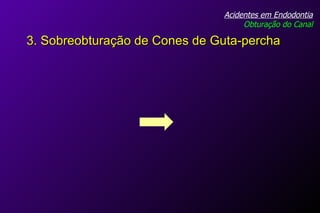 Acidentes em Endodontia Obturação do Canal 3. Sobreobturação de Cones de Guta-percha 