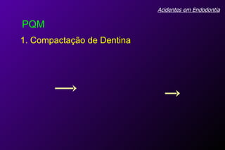 Acidentes em Endodontia PQM 1. Compactação de Dentina 