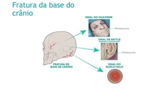 (fonte: Shutterstock).
Fratura da base do
crânio
 