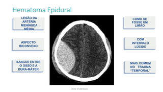 Hematoma Epidural
LESÃO DA
ARTÉRIA
MENÍNGEA
MÉDIA
ASPECTO
BICONVEXO
(fonte: Shutterstock).
COMO SE
FOSSE UM
LIMÃO
SANGUE ENTRE
O OSSO E A
DURA-MÁTER
COM
INTERVALO
LÚCIDO
MAIS COMUM
NO TRAUMA
“TEMPORAL”
 