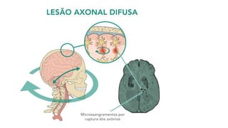 (fonte: Shutterstock).
Fratura da base do
crânio
 