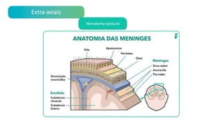 Extra-axiais
Hematoma epidural
 