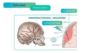 Extra-axiais
Hematoma epidural
Trauma de forte energia
Formato de lente
 