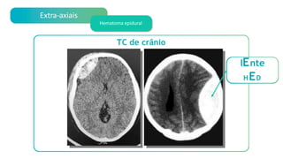 TC de crânio
Extra-axiais
Hematoma epidural
lEnte
HED
 