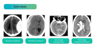 Extra-axiais
Hematoma epidural Hematoma subdural
Hemorragia
subaracnoidea
Hemorragia
intraparenquimatosa
 