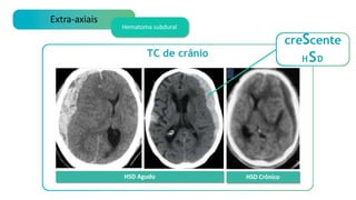 TC de crânio
Extra-axiais
Hematoma subdural
HSD Agudo HSD Crônico
creScente
HSD
 