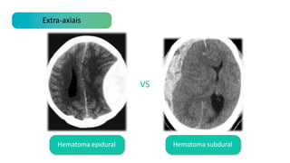 Extra-axiais
Hematoma epidural Hematoma subdural
VS
 