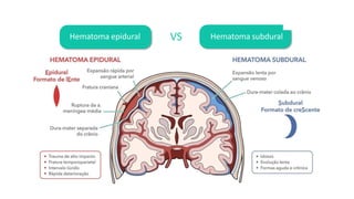 Hematoma epidural Hematoma subdural
VS
 