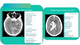 Extra-axiais
• Hemorragia subaracnoidea
• TC de crânio
• Hiperdens. sulcos
e cisternas
• Lineas de
fracturas o
contusion
cerebral
adyacentes
• Clínico
• Cefaleia, irritação
meníngea
• Menos grave que
HSA espontânea
• Tratamento
• Monitorização de
vasoespasmo
• Nimodipino
Hemorragia intraparenquimatosa
TC de crânio
•
•
•
• Hiperdens. nos
ventrículos
Clínico
• Hipertensão
intracraniana
Hidrocefalia
obstrutiva
Tratamento
Suporte
DVE se
hidrocefalia não
comunicante
 