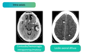 Intra-axiais
Lesão axonal difusa
Contusão/hemorragia
intraparenquimatosa
 