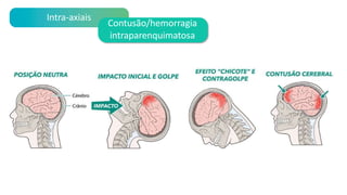 Intra-axiais
Contusão/hemorragia
intraparenquimatosa
 