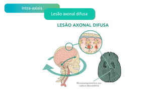 Intra-axiais
Lesão axonal difusa
 