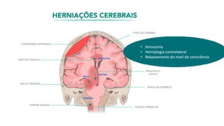 (fonte: Shutterstock).
• Anisocoria
• Hemiplegia contralateral
• Rebaixamento do nível de consciência
 
