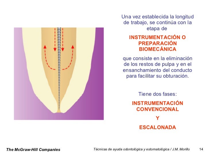 Tecnica Endodoncia
