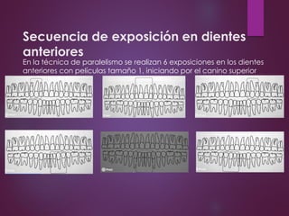 Secuencia de exposición en dientes
anteriores
En la técnica de paralelismo se realizan 6 exposiciones en los dientes
anteriores con películas tamaño 1, iniciando por el canino superior
derecho.
 