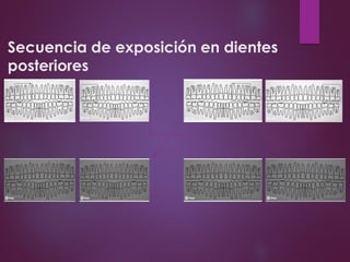 Secuencia de exposición en dientes
posteriores
 