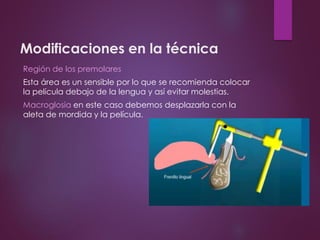 Modificaciones en la técnica
Región de los premolares
Esta área es un sensible por lo que se recomienda colocar
la película debajo de la lengua y así evitar molestias.
Macroglosia en este caso debemos desplazarla con la
aleta de mordida y la película.
 