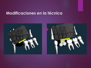 Modificaciones en la técnica
 